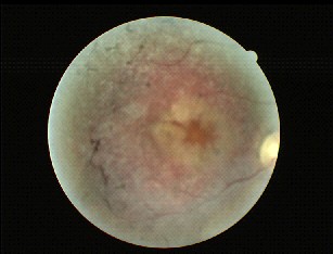 Fotografia de fundo de olho afectado por Retinitis Pigmentosa Tipica.
